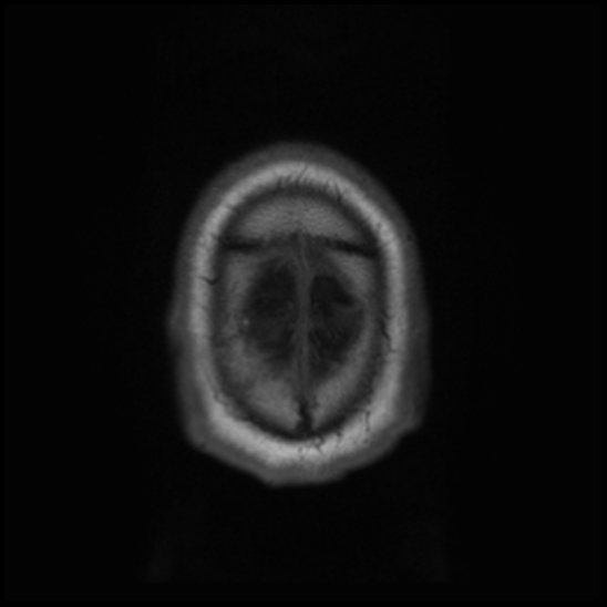 File:Cerebral abscess with ventriculitis (Radiopaedia 78965-91878 Axial T1 47).jpg