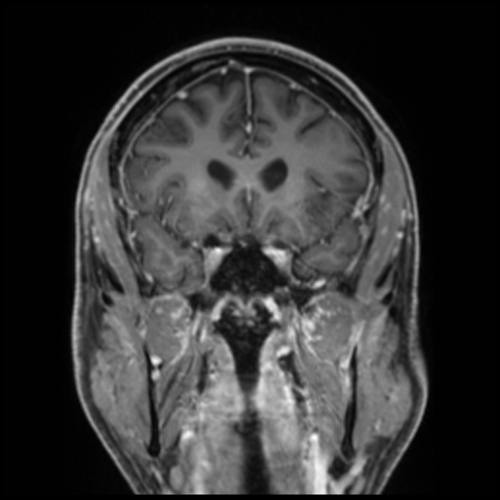 Cerebral abscess with ventriculitis (Radiopaedia 78965-91878 Coronal T1 C+ 24).jpg
