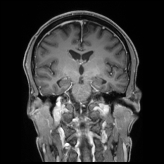 Cerebral abscess with ventriculitis (Radiopaedia 78965-91878 Coronal T1 C+ 33).jpg