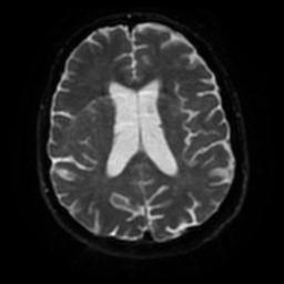 Cerebral amyloid angiopathy (Radiopaedia 28698-28978 Axial DWI 46).jpg