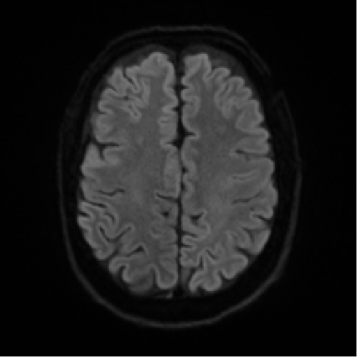 Cerebral amyloid angiopathy (Radiopaedia 46082-50433 Axial DWI 46).png