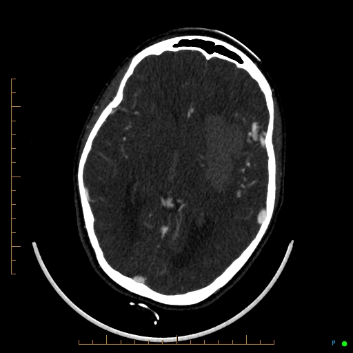 Cerebral arteriovenous malformation (AVM) (Radiopaedia 78162-90706 Axial CTA 138).jpg