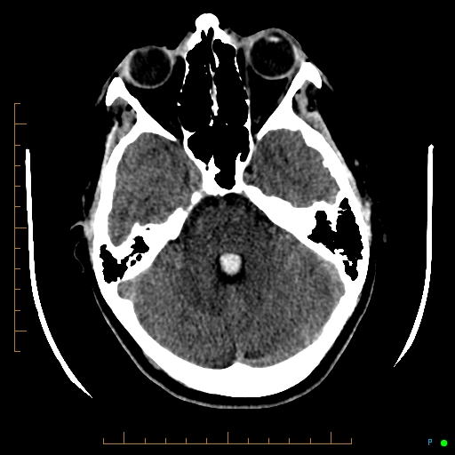 Cerebral arteriovenous malformation (AVM) (Radiopaedia 78162-90706 Axial non-contrast 20).jpg