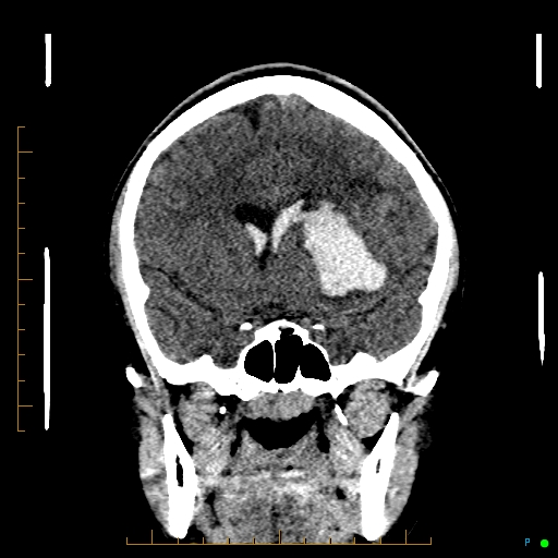 Cerebral arteriovenous malformation (AVM) (Radiopaedia 78162-90706 Coronal non-contrast 40).jpg