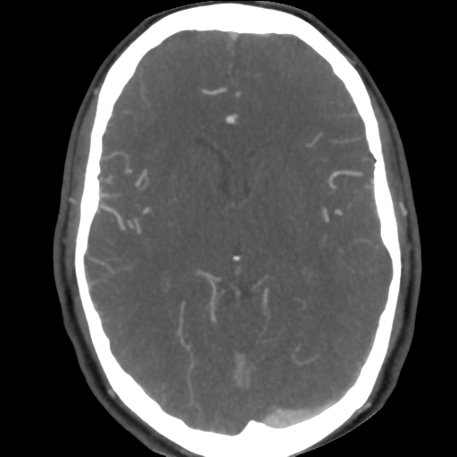 Cerebral arteriovenous malformation (Radiopaedia 39259-41505 AX CEREBRAL CTA 28).png