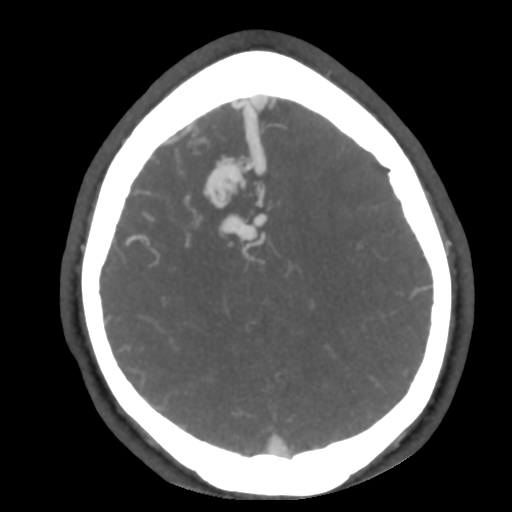 Cerebral arteriovenous malformation (Radiopaedia 39259-41505 AX CEREBRAL CTA 44).png