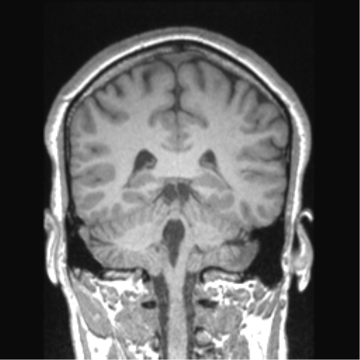 Cerebral arteriovenous malformation (Radiopaedia 39259-41506 Coronal T1 35).png