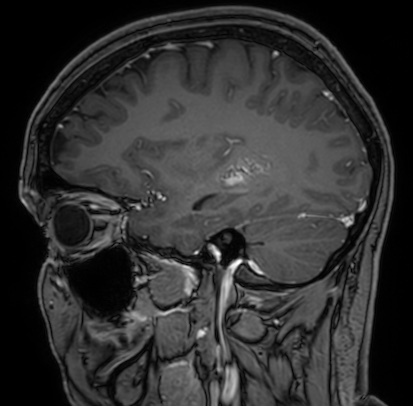 Cerebral arteriovenous malformation (Radiopaedia 74411-85654 Sagittal T1 C+ 37).jpg