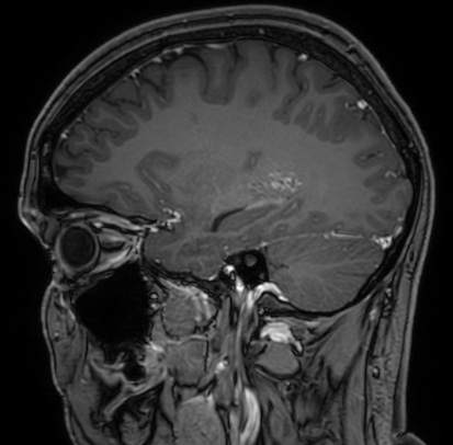 Cerebral arteriovenous malformation (Radiopaedia 74411-85654 Sagittal T1 C+ 39).jpg