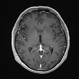 Cerebral arteriovenous malformation (Radiopaedia 84015-99245 Axial T1 C+ 79).jpg