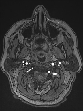 File:Cerebral arteriovenous malformation (Radiopaedia 84015-99245 Axial TOF 5).jpg