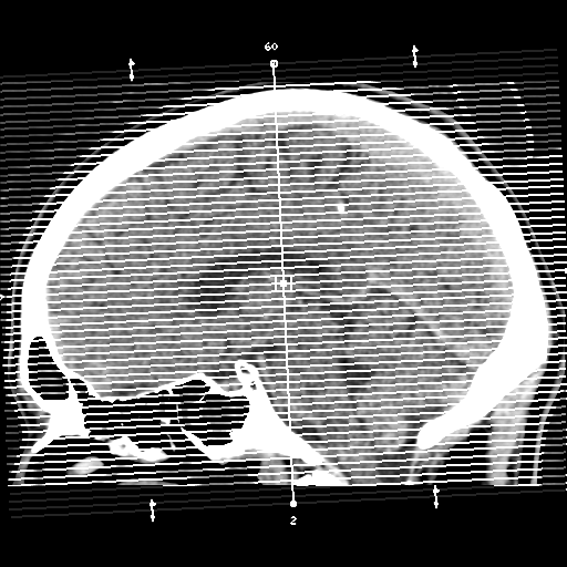 Cerebral arteriovenous malformation (Spetzler-Martin grade 2) (Radiopaedia 41262-44076 Axial non-contrast 1).png