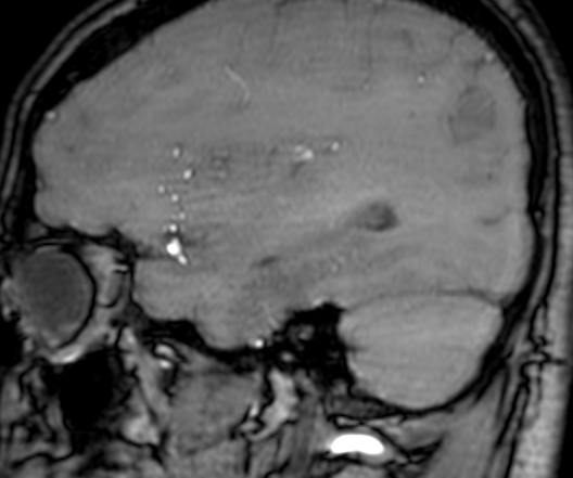 Cerebral arteriovenous malformation at posterior body of corpus callosum (Radiopaedia 74111-84925 J 91).jpg