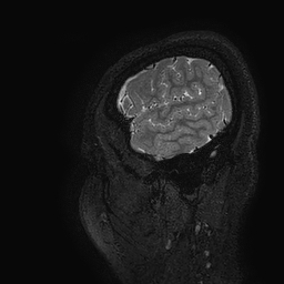 Cerebral arteriovenous malformation at posterior body of corpus callosum (Radiopaedia 74111-84925 Sagittal T2 5).jpg