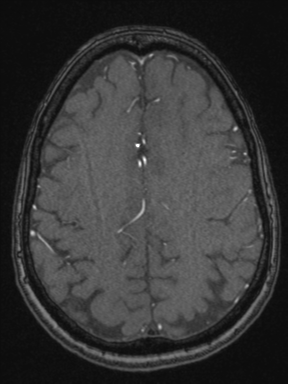 Cerebral arteriovenous malformation with hemorrhage (Radiopaedia 34422-35737 Axial MRA 62).png