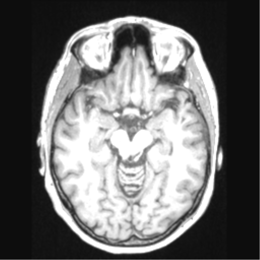 Cerebral arteriovenous malformation with hemorrhage (Radiopaedia 34422-35737 Axial T1 32).png