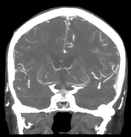 File:Cerebral arteriovenous malformation with lobar hemorrhage (Radiopaedia 44725-48511 B 27).png