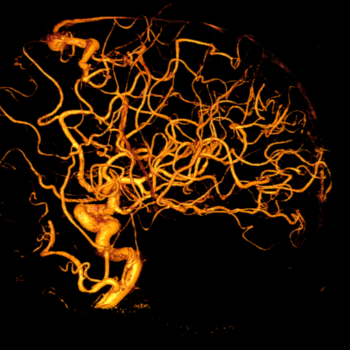 Cerebral arteriovenous malformation with lobar hemorrhage (Radiopaedia 44725-48513 Lateral 41).png