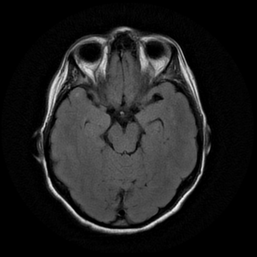 File:Cerebral autosomal dominant arteriopathy with subcortical infarcts and leukoencephalopathy (CADASIL) (Radiopaedia 41018-43763 Ax T2 Flair PROP 8).png