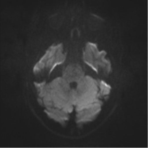 File:Cerebral cavernoma and development venous anomaly (Radiopaedia 37603-39482 Axial DWI 30).png