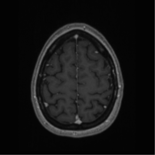 File:Cerebral cavernoma and development venous anomaly (Radiopaedia 37603-39482 Axial T1 C+ 63).png