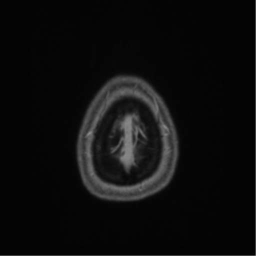 Cerebral cavernoma and development venous anomaly (Radiopaedia 37603-39482 Axial T1 C+ 74).png