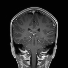 Cerebral cavernous venous malformation (Radiopaedia 70008-80021 Coronal T1 C+ 25).jpg