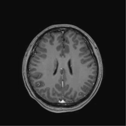 Cerebral cavernous venous malformations (Radiopaedia 48117-52946 Axial T1 C+ 40).png