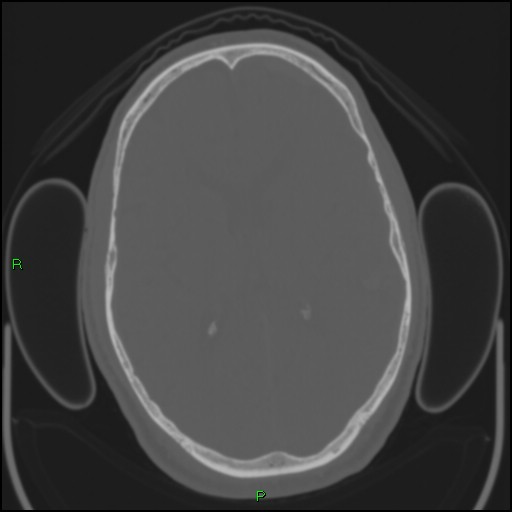 Cerebral contusions (Radiopaedia 33868-35039 Axial bone window 116).jpg