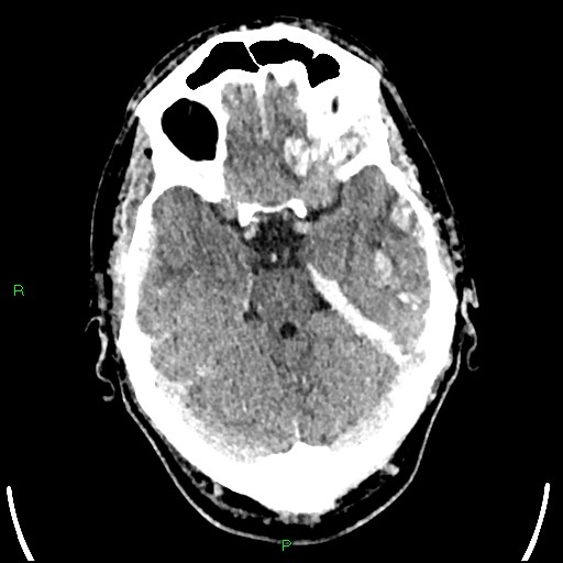 Cerebral contusions (Radiopaedia 33868-35039 Axial non-contrast 67).jpg