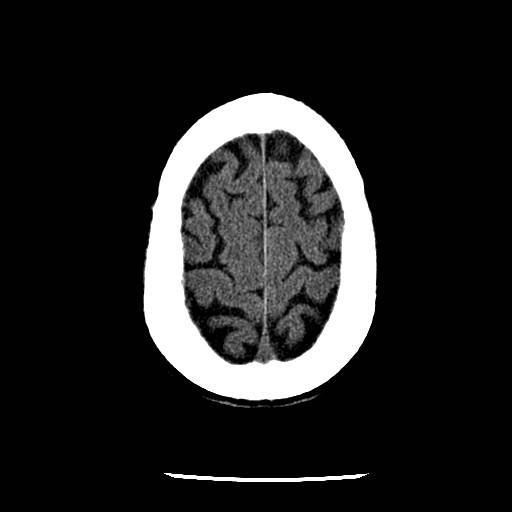 Cerebral edema (evolution in time) (Radiopaedia 19418-19441 non-contrast 80).jpg