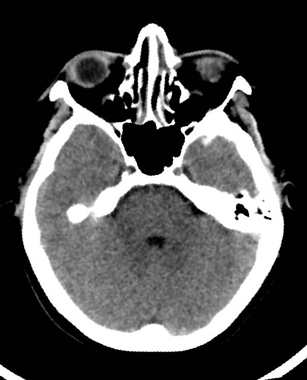 Cerebral edema due to severe hyponatremia (Radiopaedia 89826-106938 Axial non-contrast 32).jpg