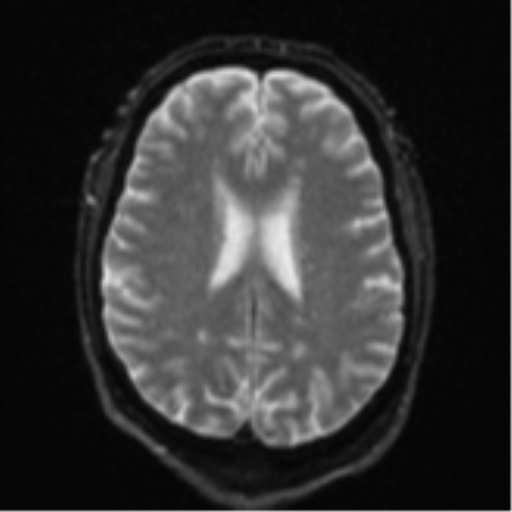 File:Cerebral embolic infarcts (embolic shower) (Radiopaedia 57395-64342 Axial DWI 23).png