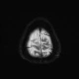 Cerebral embolic infarcts (embolic shower) (Radiopaedia 72391-82921 Axial DWI 28).jpg