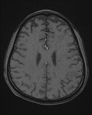 Cerebral embolic infarcts (embolic shower) (Radiopaedia 72391-82921 Axial MRA 139).jpg