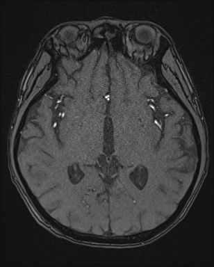 Cerebral embolic infarcts (embolic shower) (Radiopaedia 72391-82921 Axial MRA 84).jpg