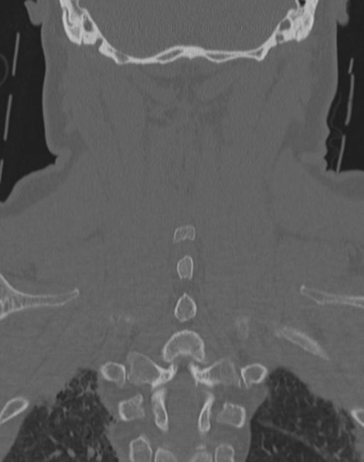 Cerebral hemorrhagic contusions and cervical spine fractures (Radiopaedia 32865-33841 Coronal bone window 58).jpg