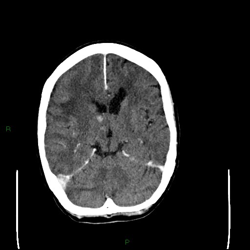 Cerebral metastases - breast primary (Radiopaedia 77653-89857 Axial C+ delayed 59).jpg