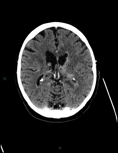 File:Cerebral metastases - ependymal and parenchymal (Radiopaedia 79877-93131 Axial C+ delayed 45).jpg