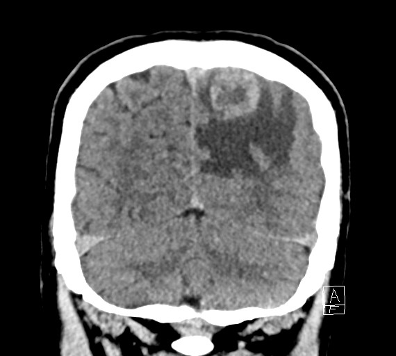 Cerebral metastases - testicular choriocarcinoma (Radiopaedia 84486-99855 Coronal C+ delayed 50).jpg
