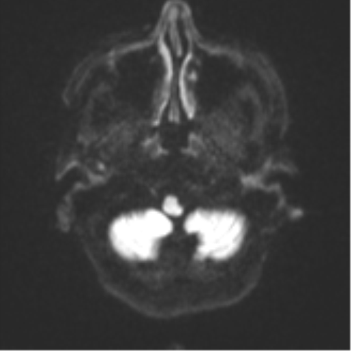 Cerebral metastasis (Radiopaedia 46744-51248 Axial DWI 31).png