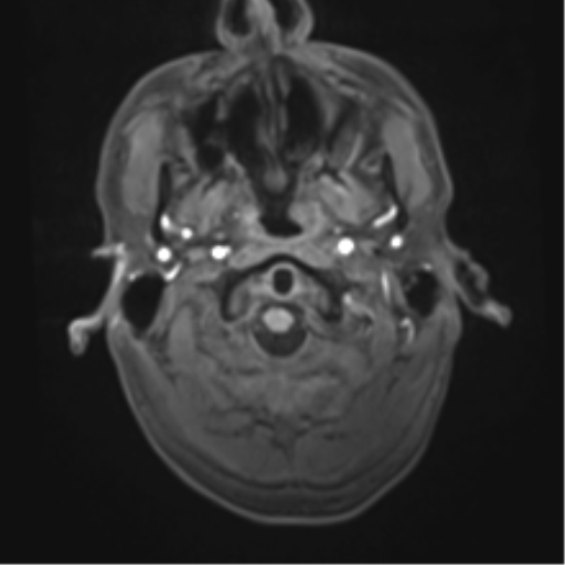 Cerebral metastasis - melanoma (Radiopaedia 54718-60954 Axial T1 4).png