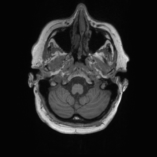 Cerebral metastasis mimicking glioblastoma (Radiopaedia 69155-78937 Axial T1 5).png