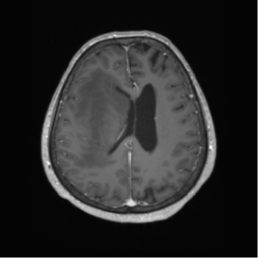 Cerebral metastasis to basal ganglia (Radiopaedia 81568-95413 Axial T1 C+ 49).png