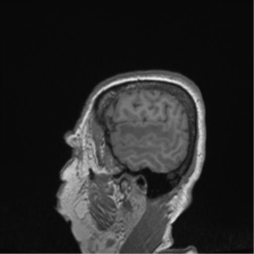 Cerebral metastasis to basal ganglia (Radiopaedia 81568-95413 Sagittal T1 69).png