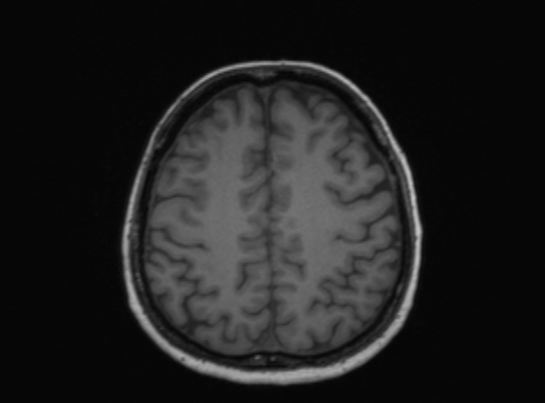 Cerebral ring enhancing lesions - cerebral metastases (Radiopaedia 44922-48817 Axial T1 165).jpg
