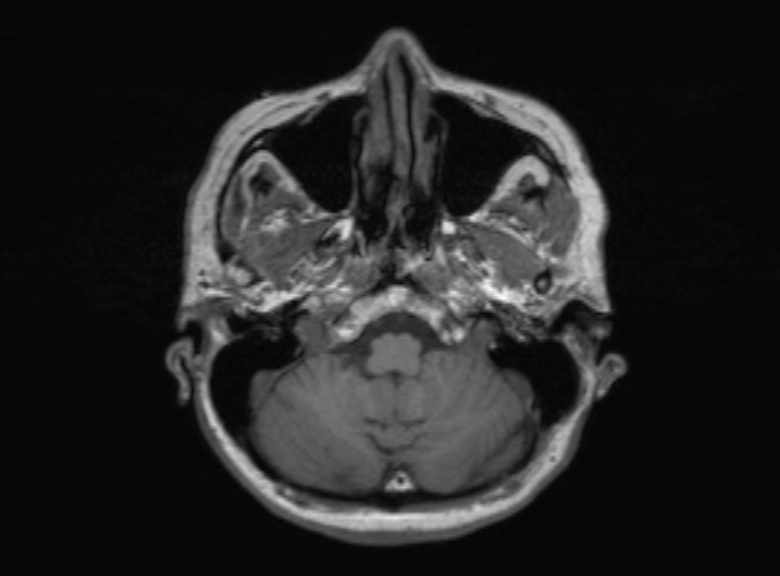 Cerebral ring enhancing lesions - cerebral metastases (Radiopaedia 44922-48817 Axial T1 324).jpg