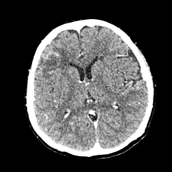 Cerebral ring enhancing lesions - cerebral metastases (Radiopaedia 44922-48818 B 155).jpg
