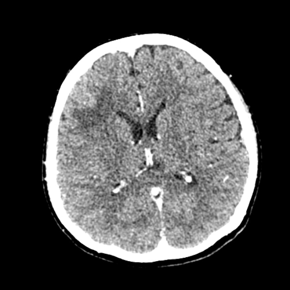 File:Cerebral ring enhancing lesions - cerebral metastases (Radiopaedia 44922-48818 B 164).jpg