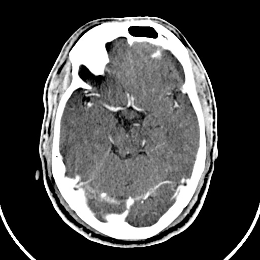 File:Cerebral venous angioma (Radiopaedia 69959-79977 B 28).jpg
